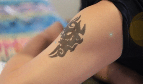tattoo laser machine