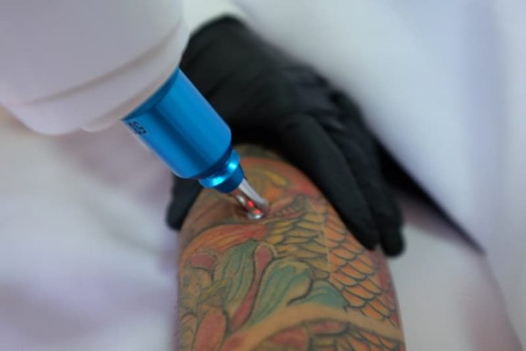 tattoo laser removal machine