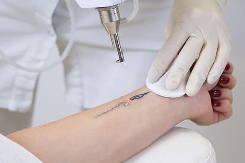 tattoo remove machine