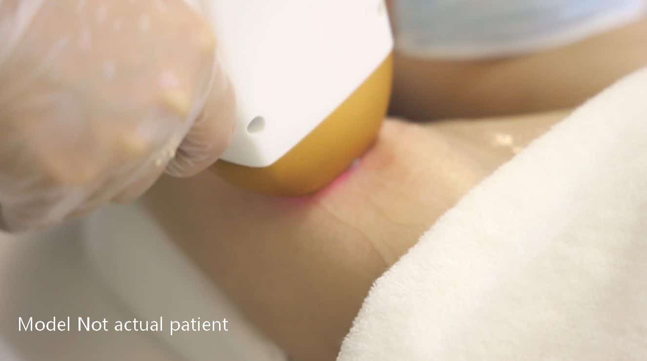 Portable Hair Removal Apparatus 808-O Treatment Procedure