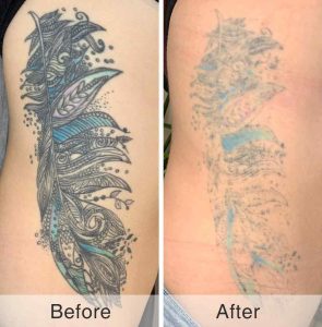 Picosecond Laser Treatment