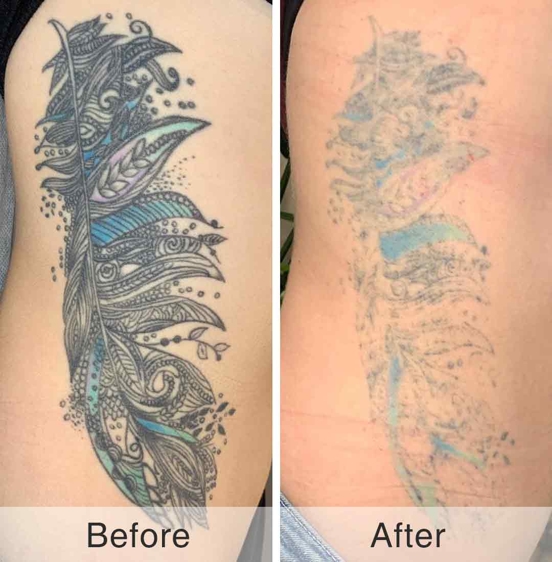 Picosecond Laser Treatment